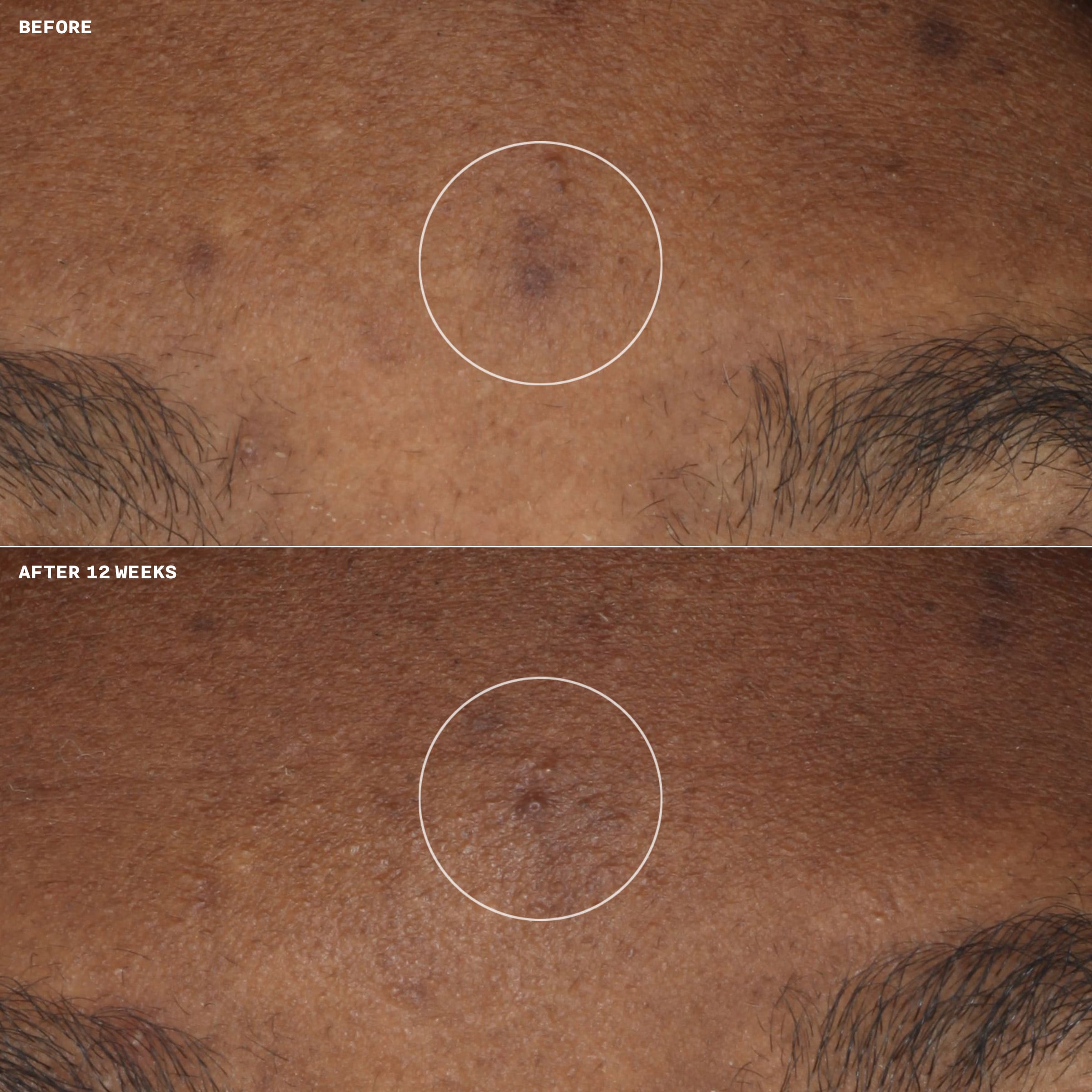 Even Better Clinical™ Brightening Moisturizer | Clinique