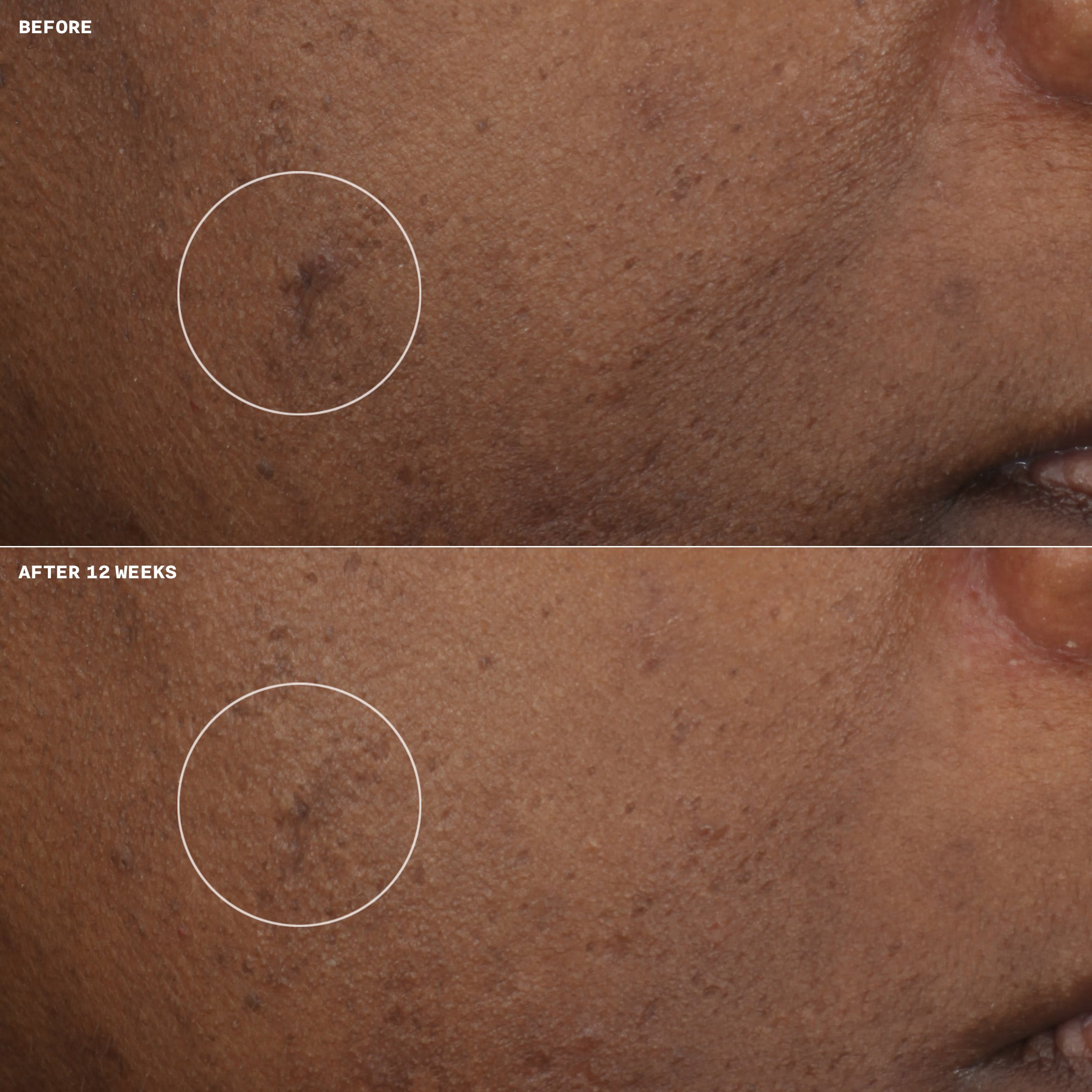 Even Better Clinical™ Brightening Moisturizer | Clinique