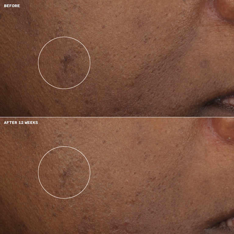 Even Better Clinical&trade; Hidratante Iluminador Clinical, Model, Deep Skin Tone