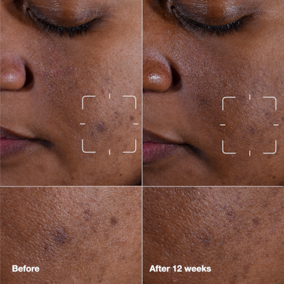 Even Better Clinical™ Dark Spot Clearing Serum