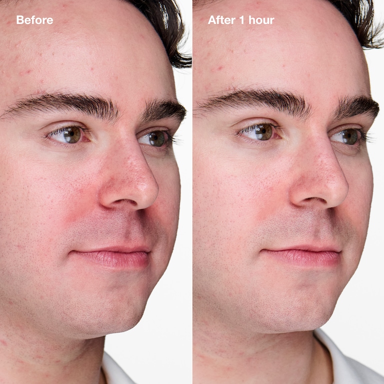 Anti-Blemish Solutions Clinical™ Gel purifiant avancé