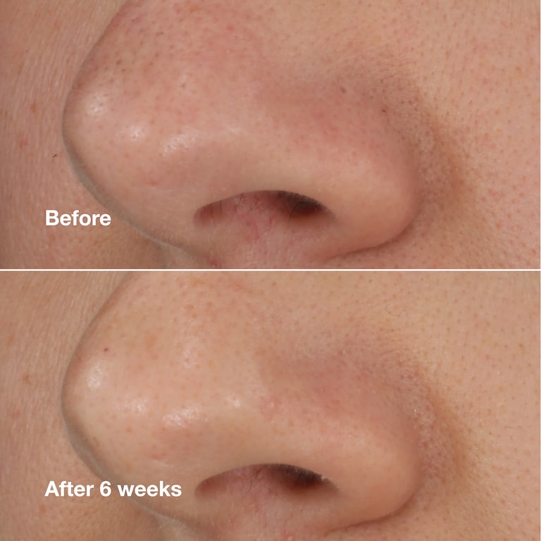 Blackhead Solutions Extracteur Points Noirs Auto-Chauffant